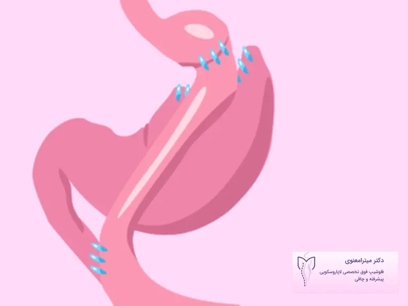 عوارض-مینی-بای-پس-معده