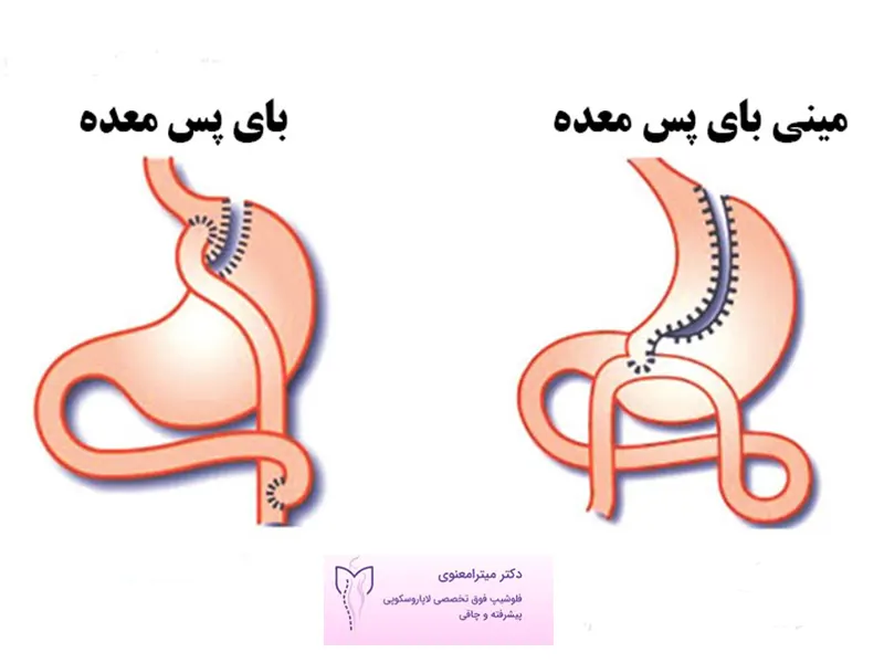 مینی-بای-پس-معده