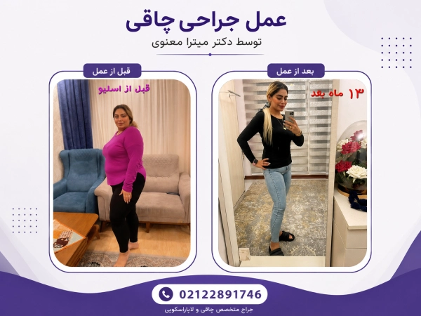 قبل و بعد از جراحی چاقی
