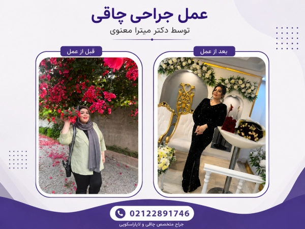 عکس قبل و بعد از جراحی چاقی