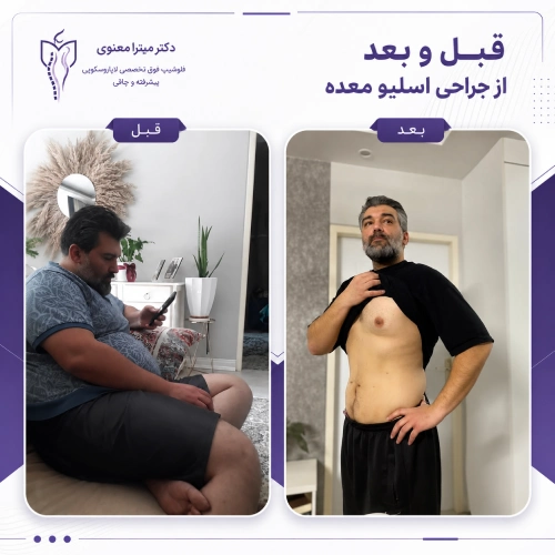 نتیجه جراحی اسلیو معده