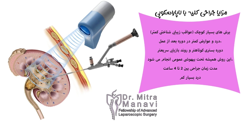 مزایا لاپاراسکوپی کلیه
