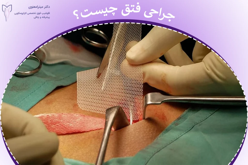 جراحی فتق